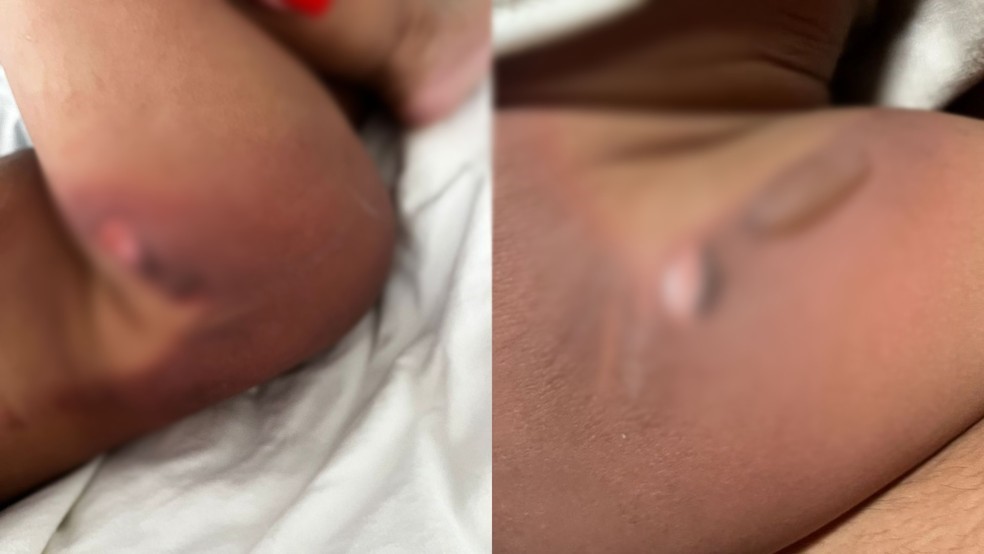 ​PAI RECLAMA DE DEMORA NO SOCORRO APÓS FILHO SOFRER QUEIMADURAS EM CRECHE DE JAÚ: "MEU FILHO FICOU SOFRENDO”